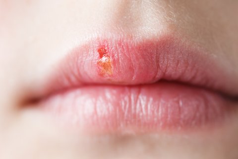 Nahaufnahme der Lippen einer Person mit einem sichtbaren Lippenherpes, auch bekannt als Herpes labialis, an der Oberlippe. Der Bereich ist ger&ouml;tet und weist einen kleinen gelblichen Schorf auf, der typisch f&uuml;r eine Herpes-simplex-Infektion ist.