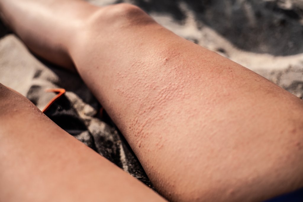 Nahaufnahme der Oberschenkel einer Person mit sichtbarer Cellulite oder strukturierter Haut, während sie auf einer sandigen Oberfläche liegt, möglicherweise mit Anzeichen von Sonnenallergie.